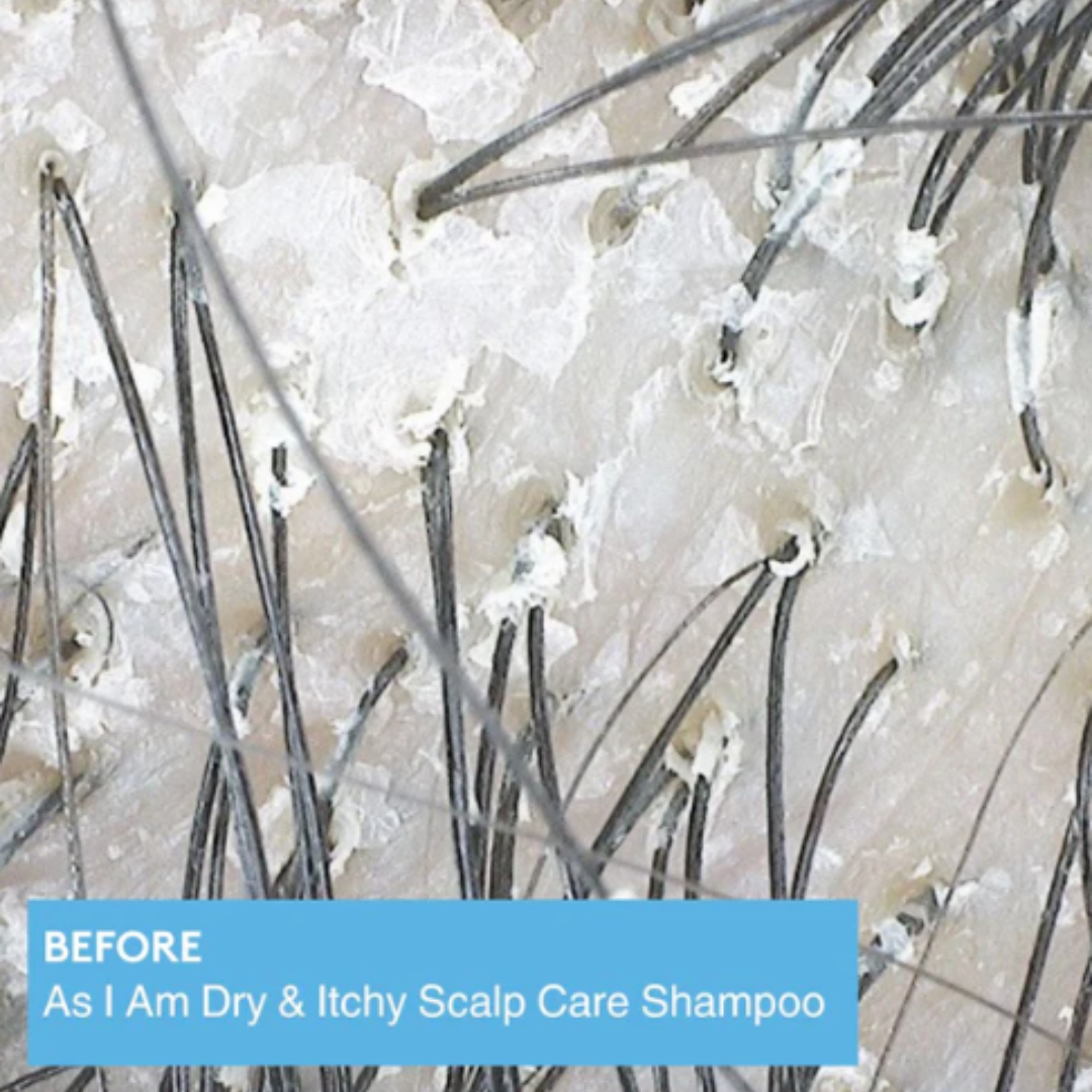 Close-up of a scalp with hair follicles and dark hair strands, with a blue text banner at the bottom reading 'BEFORE As I Am Dry & Itchy Scalp Care Shampoo'.