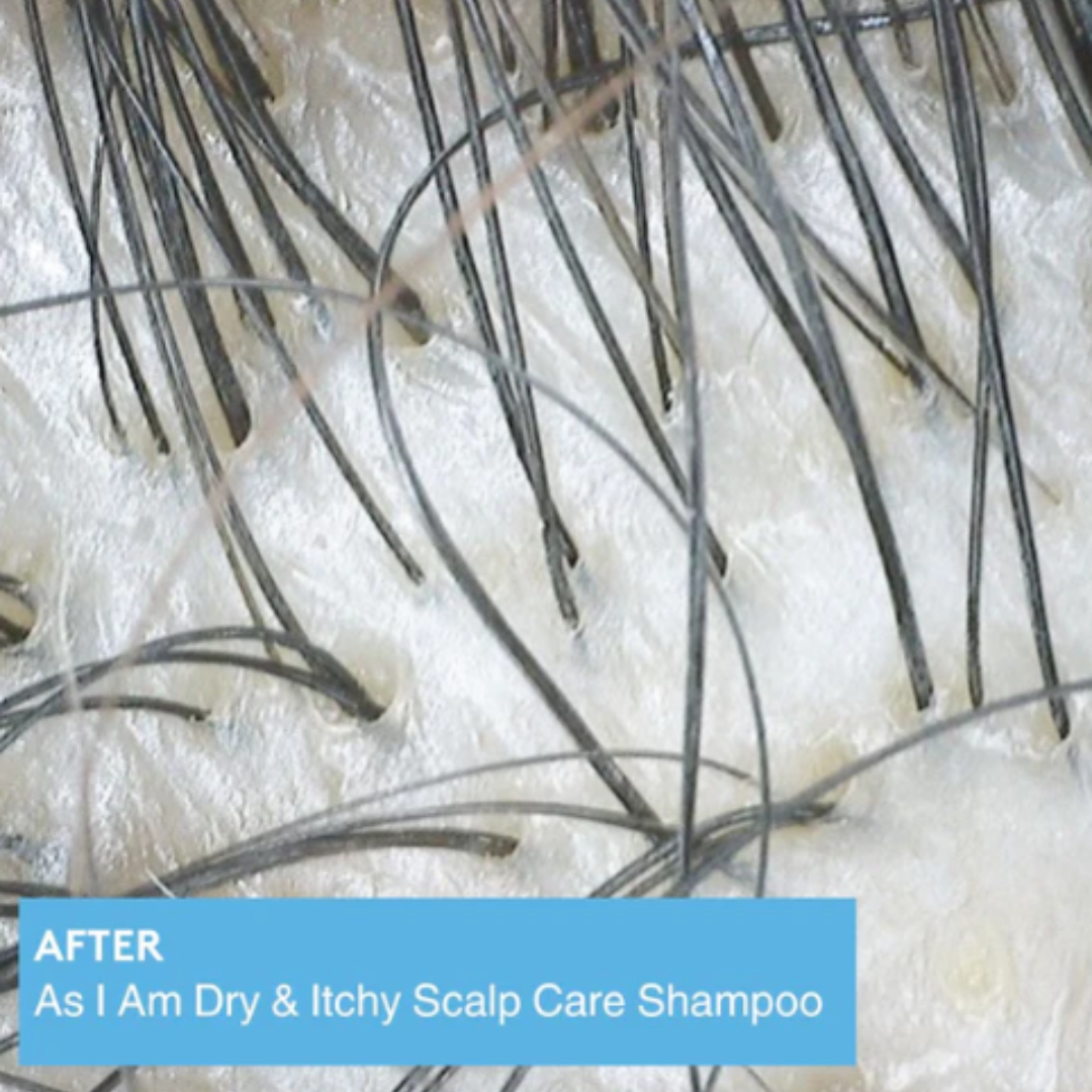 Close-up of a scalp with dark hair strands on white skin, with a blue text banner at the bottom reading 'AFTER As I Am Dry & Itchy Scalp Care Shampoo'.